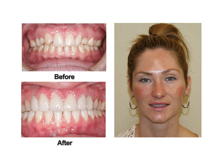 Maria Elder smile before and after