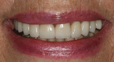Patient Case 3 implants after