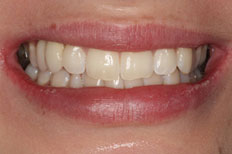 Bridges Patient Case 1 after