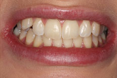 Bridges Patient Case 1 before