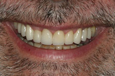 Patient Case 1 After Crowns