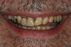 Patient Case 1 before crowns