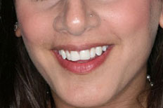 Crowns Patient Case 2 after