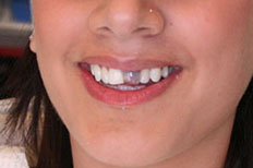 Crowns Patient Case 2 before