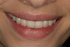 After Veneers Patient Case 1