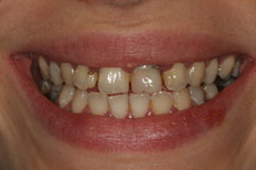 Before Veneers Patient Case 1